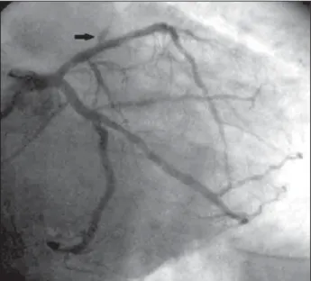 Fig. 2 - Evolution of platelet count during hospitalization. Fig. 3 - Caudal RAO view of the LC artery after PTCA; the arrow shows the flow reduction in the RC artery.