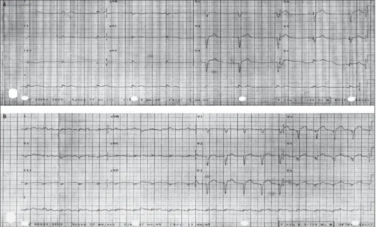 Fig. 2 - Left coronary artery in the cranial RAO and LAO views, showing coronary arteries with no severe obstructive lesions.