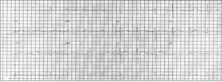 Fig. 4 - Electrocardiogram showing complete recovery of the R waves in the anterior wall.