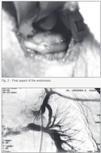 Fig. 1 - Re-hydration of the D-hydro graft in saline solution and heparin at the time of implantation.