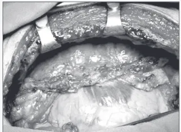 Fig. 1 - Randomization of the patients. Fig. 2 - Pedicled dissection of the left internal thoracic artery.