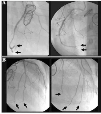 Fig. 2  - Arteriografia das coronárias direita (A) e esquerda (B) m ostrando imagens múltiplas e típicas de embolismo distal (setas).