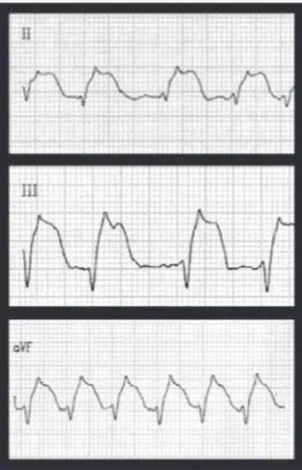Fig. 1 - Emergency electrocardiogram: elevation in the ST segment in the II, III, and aVF leads.