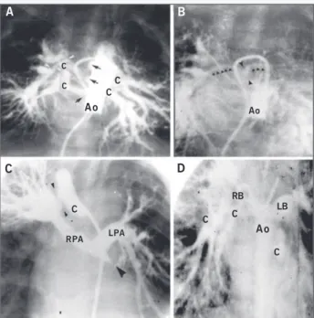 Fig. 3 – Type III. A) Initial phase: multiple collaterals (4) are seen perfusing all segments of both lungs