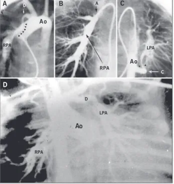 Fig. 5 - Type V. A) Aortography in PA view. Presence of ductus arteriosus at the right-hand side of the aortic arch, perfusing the right pulmonary artery