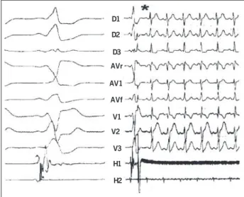Fig. 3 - EKG recording showing antidromic tachycardia (180 bpm) induced by ventricular stimulation