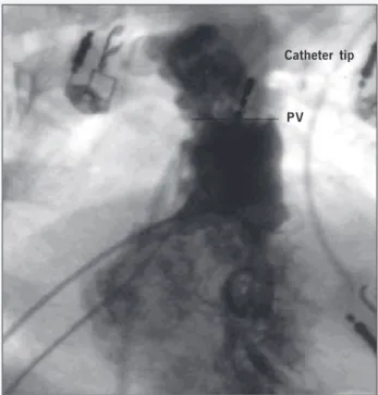 Fig. 3 - Right ventricular angiography showing the site of radiofrequency application (catheter tip) that resulted in the disappearance of ventricular tachycardia