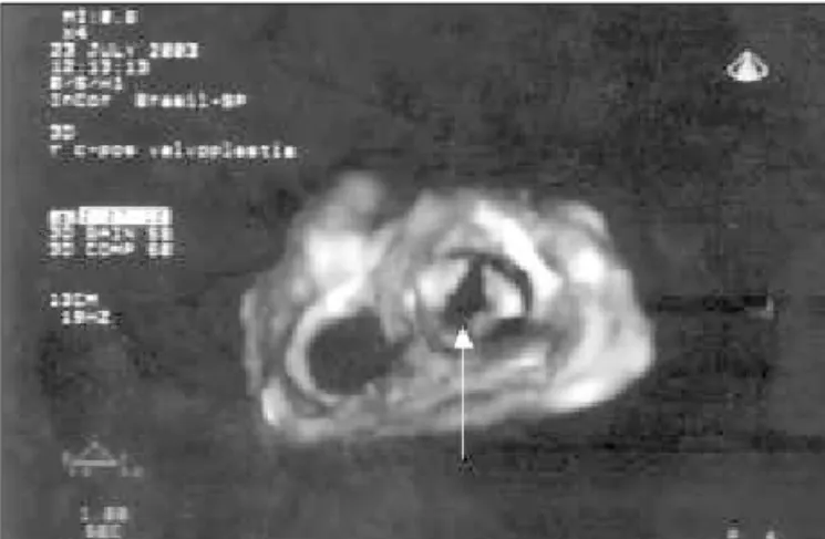 Fig. 3  - Ecocardiograma transtorácico tridimensional em tempo real, projeção trans- trans-versal, visão do ventrículo esquerdo para o átrio esquerdo, pós valvoplastia mitral.