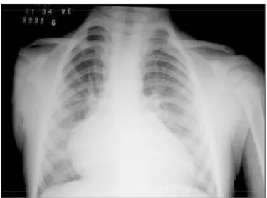 Fig. 1  - Radiografia de tórax mostra aumento biventricular e do átrio esquerdo com trama vascular pulmonar aumentada.