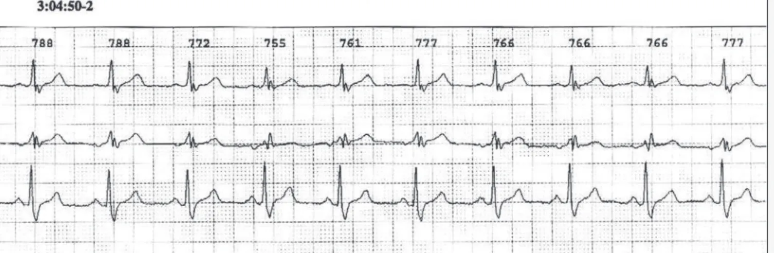 Fig. 3 - Modified Holter leads showing nonsustained ventricular tachycardia.
