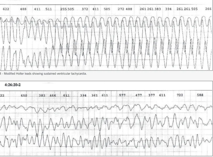 Fig. 4 - Modified Holter leads showing sustained ventricular tachycardia.