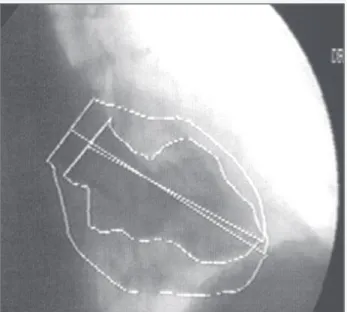 Fig. 5 - Left ventriculography on RAO projection.