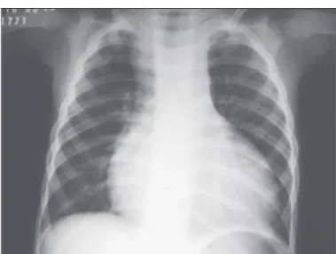 Fig. 1 - Radiografia de tórax mostra acentuado aumento do ventrículo esquerdo, e trama vascular pulmonar diminuída.