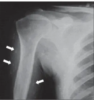 Fig. 1 – Simple x-ray of soft tissues, showing microcalcifi cations