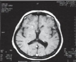 Fig. 2 – Computerized tomography of the brain showing cerebral  calcifi cations