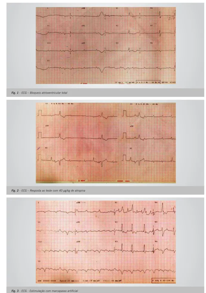 Fig. 1 - ECG – Bloqueio atrioventricular total