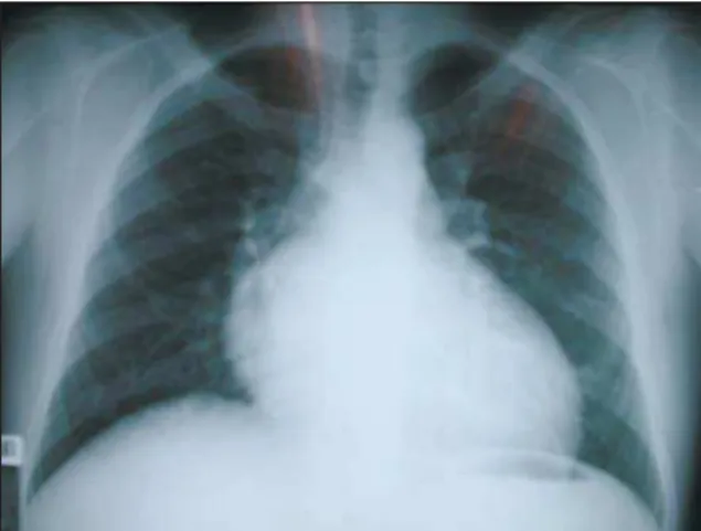 Fig. 1 - Radiografi a de tórax salienta a forma cardíaca ovalada, o pedículo  vascular estreito e a trama vascular pulmonar aumen tada, elementos  radiográfi cos característicos da transposição das grandes artérias