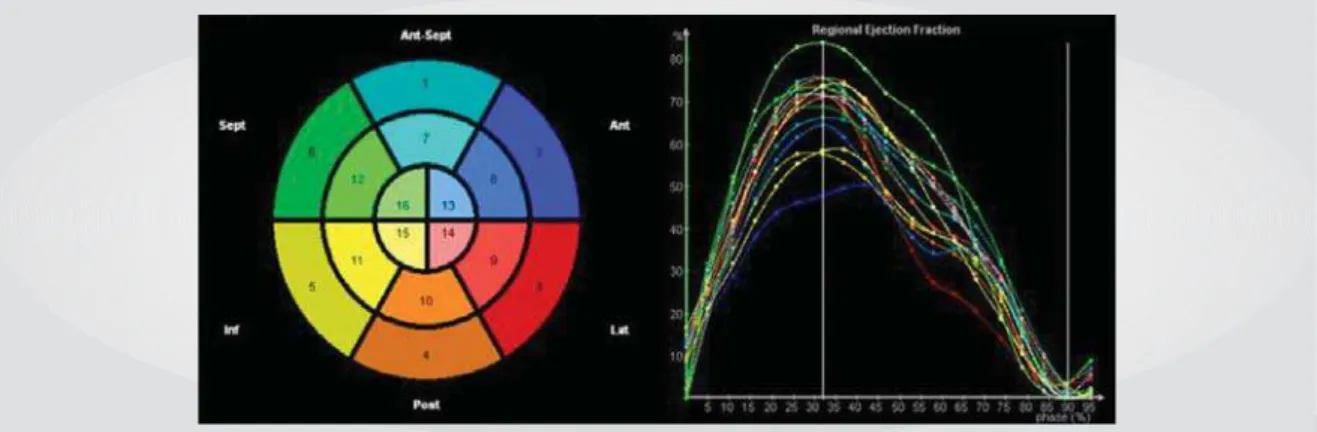 Fig. 1 - Regional left ventricular contraction in a 16-segment model of the left ventricle using real-time 3D echocardiogram