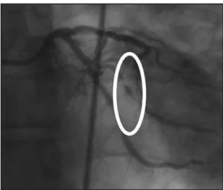 Fig. 1 - Obstructive lesion of 90% at the marginal branch of the circumflex artery