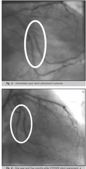 Fig. 3 - Immediate post-stent placement outcome