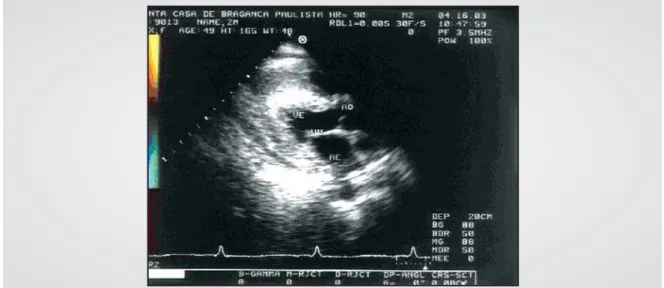 Fig. 1 - Longitudinal paraesternal transthoracic echocardiogram showing acoustic texture with thick granulations and apical obliteration due to a deposit of fibrotic tissue