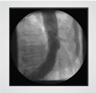 Fig. 4 - Control TC  of the chest after stent implantation in the aorta
