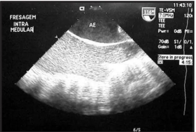 Fig. 2 - Marrow material coalescing in small pieces (arrow) were also seen passing through right heart