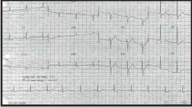 Fig. 1 – Eletrocardiograma - Sobrecarga de ventrículo esquerdo.