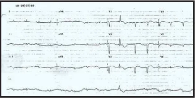 Fig. 2 – Eletrocardiograma - Complexos QRS de baixa voltagem no plano frontal, área eletricamente inativa parede anterior e supradesnivelamento do segmento ST em parede ântero-septal.
