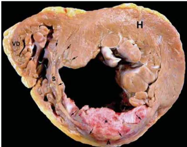 Fig. 3 - Corte transversal do coração mostrando extenso infarto do miocárdio (delimitado pelas cabeças de seta), acometendo a parede anterior (A) do ventrículo esquerdo e metade anterior do septo (S).