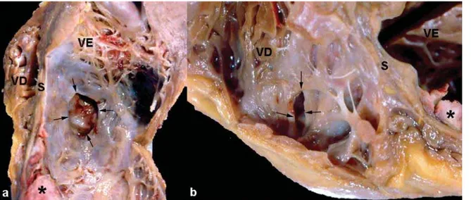 Fig. 4 - Detalhe do septo na região apical anterior, mostrando a comunicação interventricular pós-infarto (seta), cujo orifício em fenda mede cerca de 1,5cm, vista pelo ventrículo direito, seccionado na parede anterior (VDA),