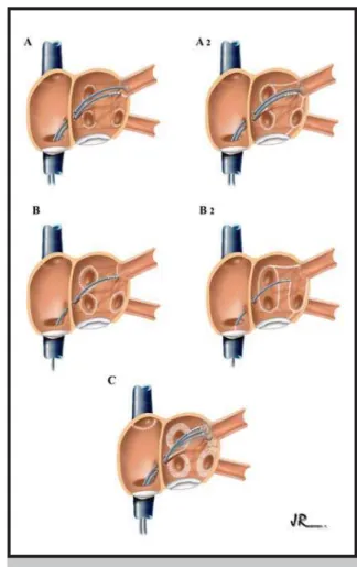 Fig. 1 - Most widely used strategies for catheter ablation of atrial fibrillation. A1 - Segmental pulmonar y vein ablation - the technique first proposed by the Hospital Haut-Lévêque group, in Pessac, France, for electrical isolation of the four pulmonary 