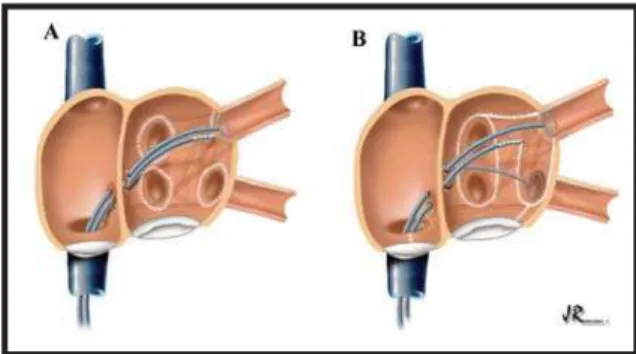 Fig. 2 - Techniques used at InCor-HC-FMUSP for catheter ablation of atrial fibrillation