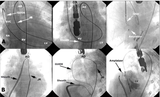Fig. 2 - In A, the closure sequence of a muscular IVSD. In B, the necessary steps for the closure of a perimembranous IVSD.