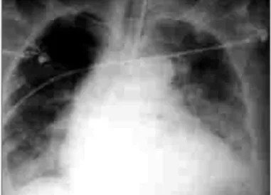 Fig. 2 - ECG showing changes in ventricular repolarization on anterior wall.