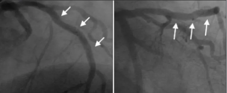 Fig. 3 - LAD after stent implantation. Excellent angiographic result with less than 10% residual lesion.