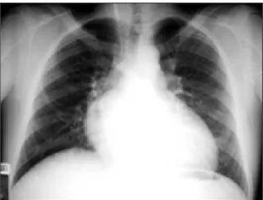 Fig. 1  - Radiografia de tórax salienta a forma cardíaca ovalada, o pedículo vascular estreito e a trama vascular pulmonar aumentada, elementos radiográficos característicos da transposição das grandes artérias.