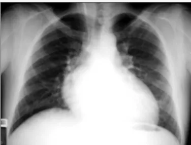 Fig. 1 - Thoracic radiography highlighting oval cardiac shape, narrow vascular peduncle and increased pulmonary vascular network, radiographic elements characteristic of transposition of the great arteries.