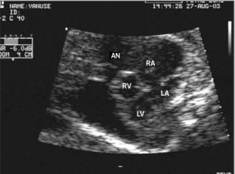 Fig. 1 - Fetal echocardiogram: cross-section of 4 chambers showing aneurysm of right atrium (AN)