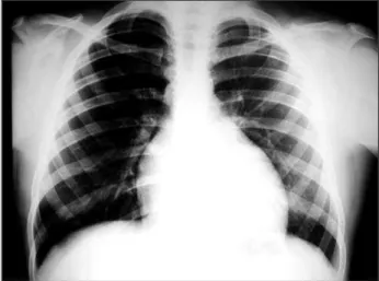 Fig. 2 – Thoracic radiography emphasizes moderate increase of right heart cavities with diminished pulmonary vascular bed.