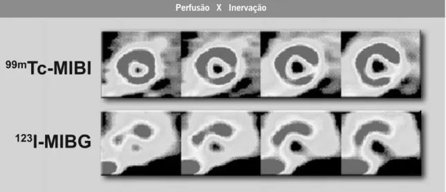Figura 2 - Paciente portador de doença de Chagas. As imagens superiores correspondem à cintilografia de perfusão miocárdica em que se observa discreta alteração perfusional na parede ínfero-lateral