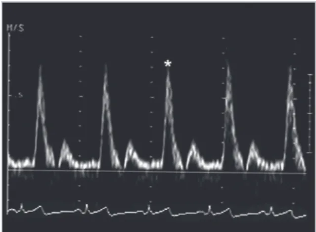 Fig. 2 - Flow velocity variation curve in the brachial artery showing  the reference point for analysis of the systolic peak velocity (Vsy); 