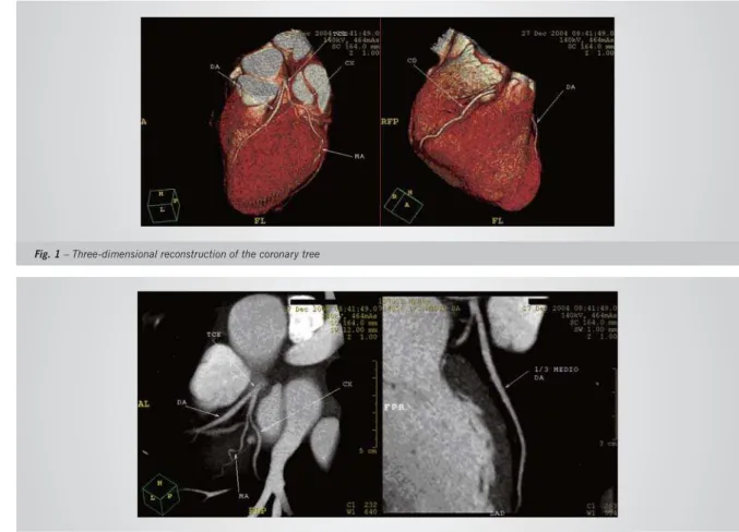 Fig. 1 – Three-dimensional reconstruction of the coronary tree