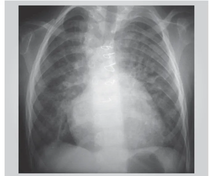 Fig. 1- Radiografi a de tórax mostra a forma cardíaca semelhante à encontrada na tetralogia de Fallot