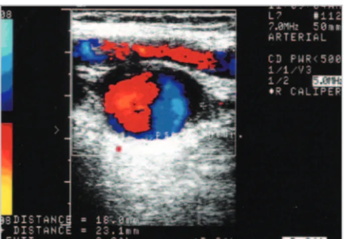 Fig. 1 – Fotografi a do resultado do ecocolor Doppler mostrando o  pseudo-aneurisma de artéria axilar direita