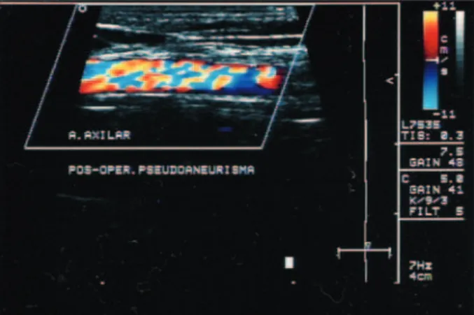 Fig. 2 – Fotografi a do resultado do ecocolor Doppler mostrando artéria  axilar direita após correção cirúrgica