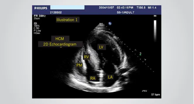 Fig. 1 - Transthoracic bidimensional echocardiogram (2D) (4-chamber apical projection) of patient,  showing hypertrophy at medium and basal segments  of interventricular septum