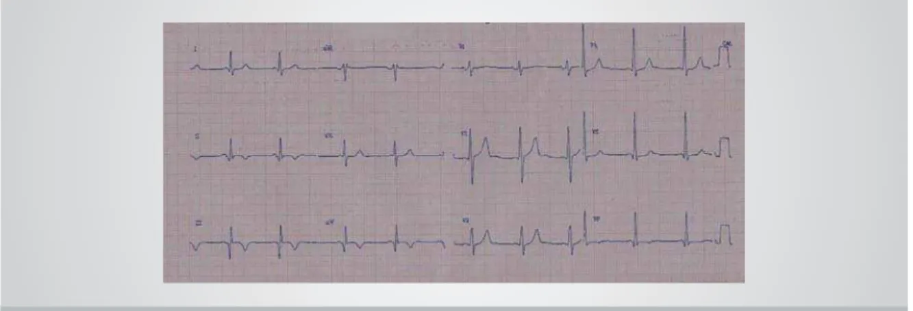 Fig. 1 – Electrocardiogram showing inactive area in inferior wall