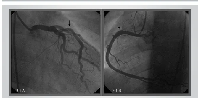 Fig. 3.1.A – Left anterior descending. Angio after stent implant); 3.1.B - Right coronary control coronariography: showing dissolution of intracoronary  thrombus (Arrows)