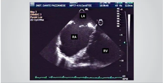 Fig. 1 - Complex ASD with multiple orifi ces shown by TEE. RA: right atrium; LA: left atrium; RV: right ventricle